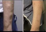Vedas Cure Lipoma Treatment Reviews