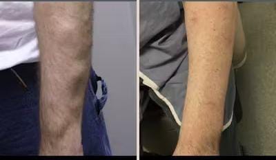 Vedas Cure Lipoma Treatment Reviews