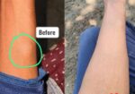 Vedas Cure Lipoma Treatment Reviews