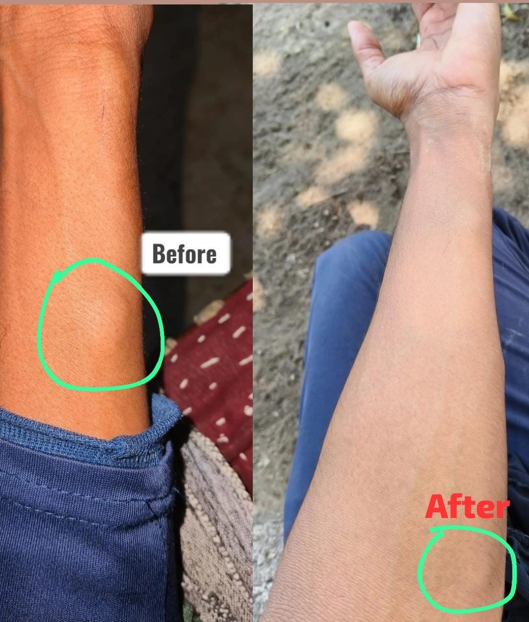 Vedas Cure Lipoma Treatment Reviews