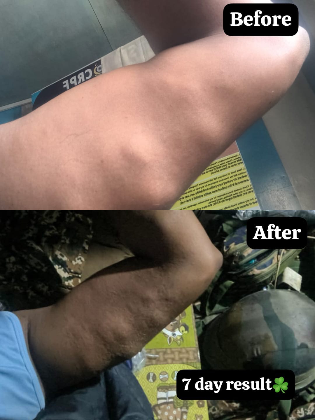 Vedas Cure Lipoma Treatment Reviews