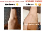 Vedas Cure Lipoma Treatment Reviews