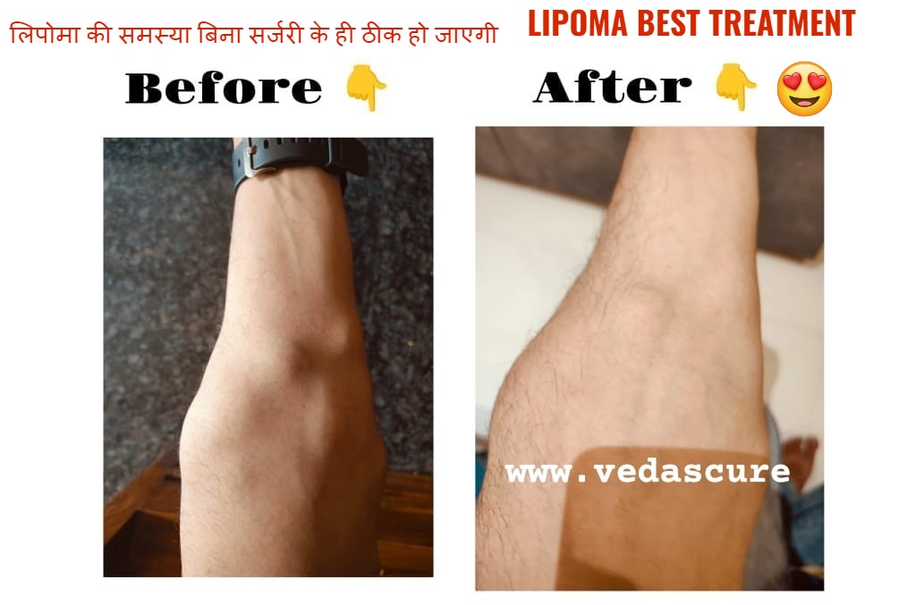Vedas Cure Lipoma Treatment Reviews