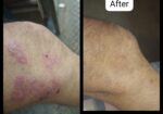 Vedas Cure Psoriasis Treatment Reviews