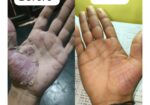 Vedas Cure Psoriasis Treatment Reviews