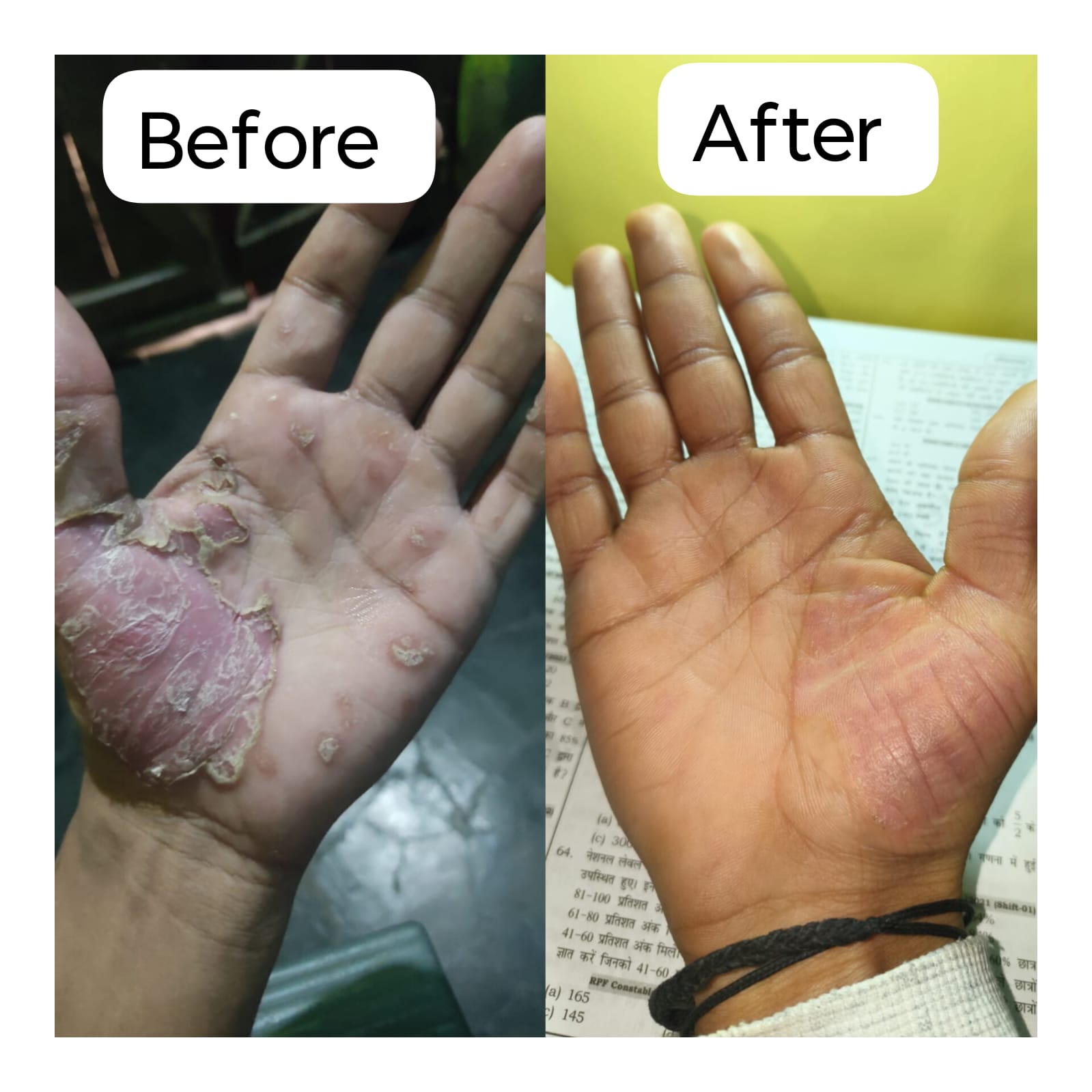 Vedas Cure Psoriasis Treatment Reviews