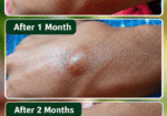 Vedas Cure Lipoma Treatment Reviews