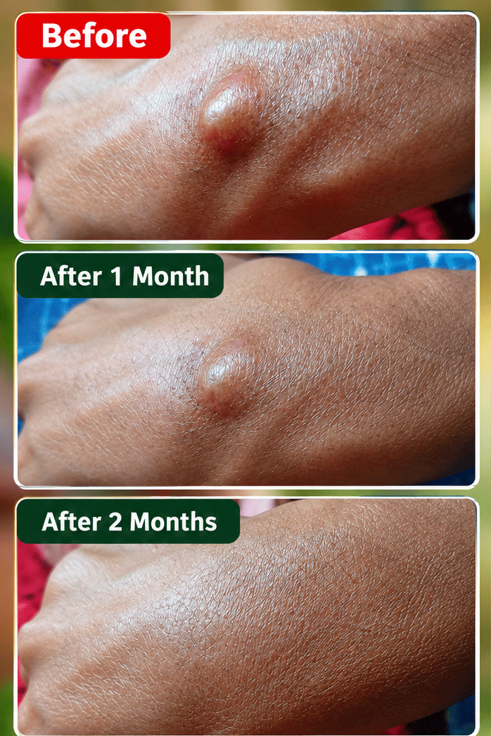 Vedas Cure Lipoma Treatment Reviews