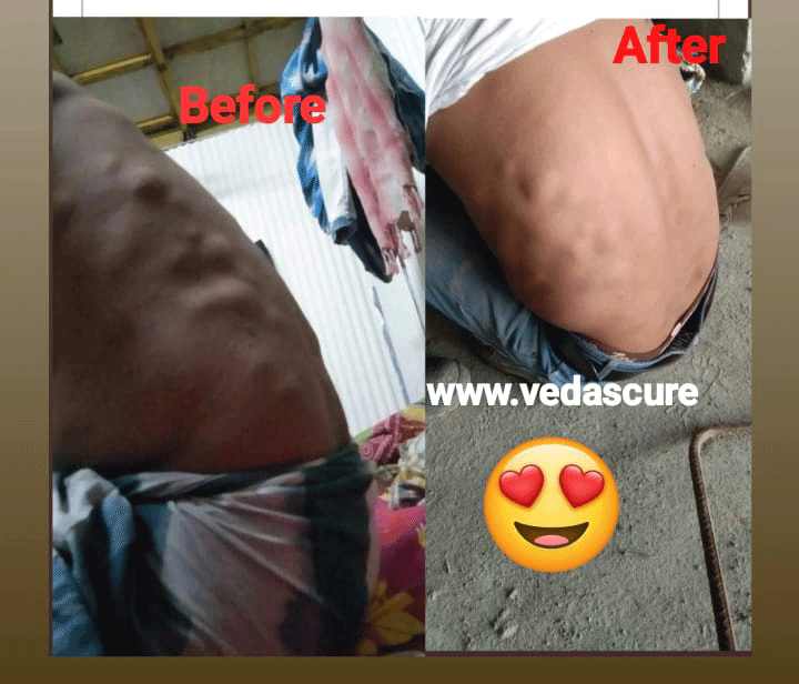 Vedas Cure Lipoma Treatment Reviews